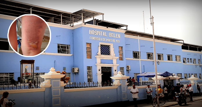 Mujer ingresa a dar a luz y sale con quemaduras de segundo grado en Hospital Belén