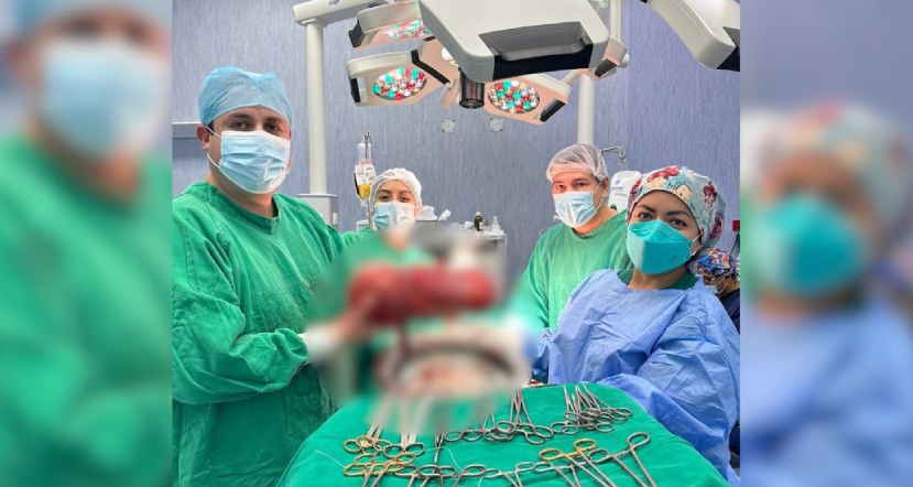 Médicos de EsSalud extraen tumores de más de 15 kilos del útero de una paciente en La Libertad