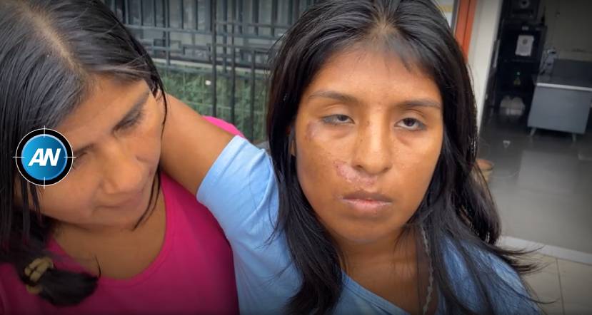 Joven atropellada denuncia que su padre habría cobrado S/ 20,000 sin su consentimiento
